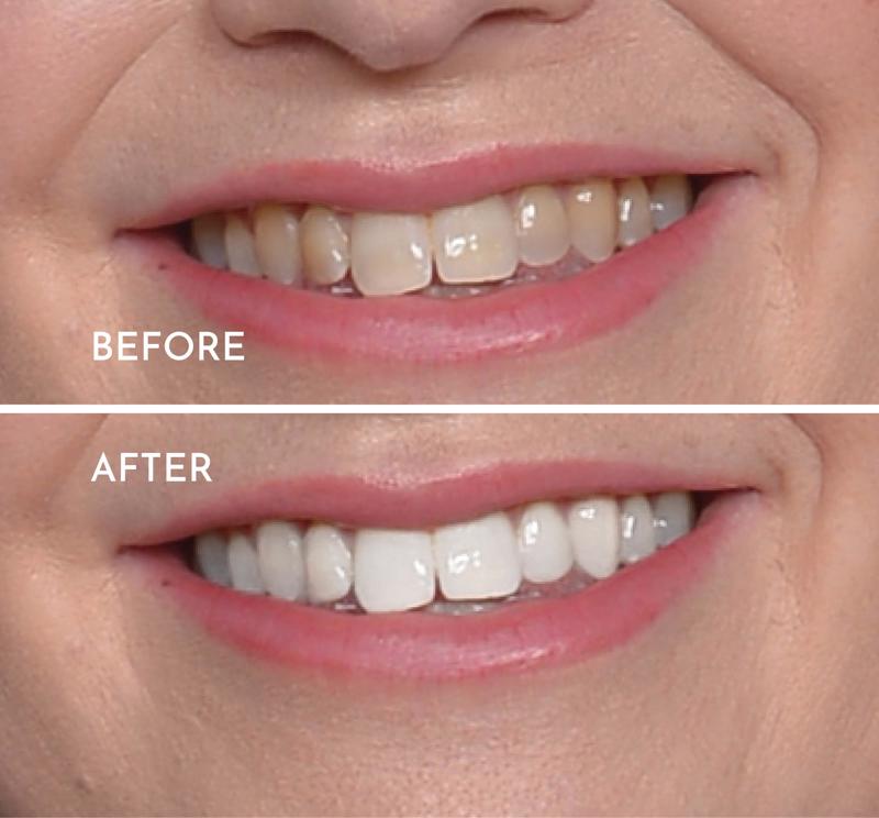 Teeth Whitening - 1