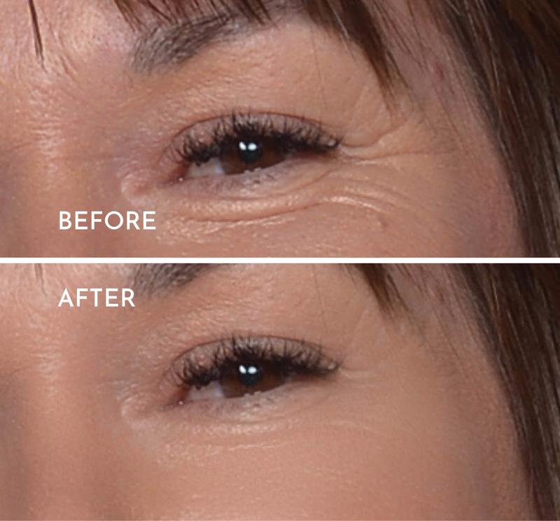 Wrinkle reduction - 1